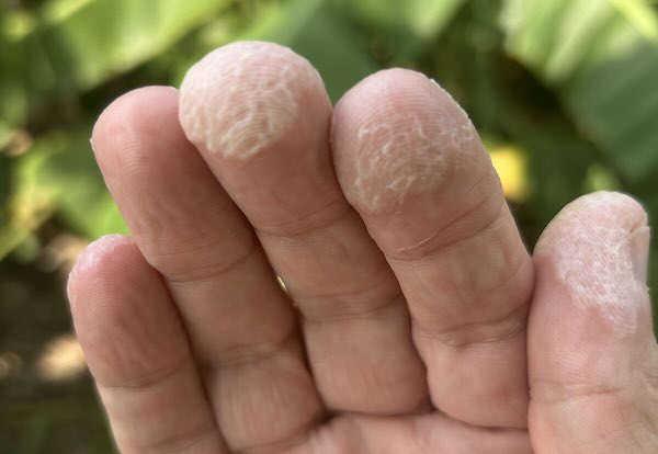 Damaged fingertips after biting and tearing skin repeatedly over years.